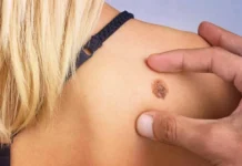 Під час профілактичних оглядів у Києві виявляють 85% випадків раку шкіри